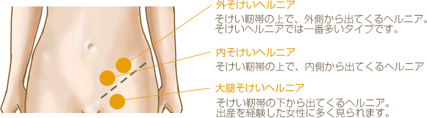 外そけいヘルニア：そけい靭帯の上で、外側から出てくるヘルニア。そけいヘルニアでは一番多いタイプです。　内そけいヘルニア：そけい靭帯の上で、内側から出てくるヘルニア。　大腿そけいヘルニア：そけい靭帯の下から出てくるヘルニア。出産を経験した女性に多く見られます。